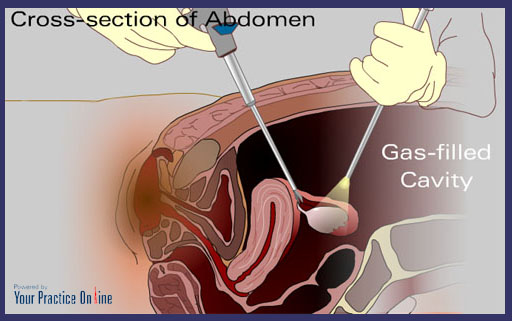 Pelvic Keyhole gynecology surgery houston texas